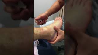 Graston Technique on a grade 2 ankle sprain [upl. by Sregor705]