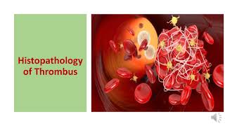 THROMBOSIS TYPES  HISTOPATHOLOGY CONSEQUENCES DIAGNOSIS AND PREVENTION [upl. by Snoddy116]