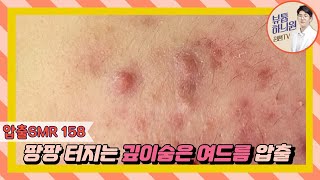 압출SMR 158 안에 숨은 씨앗이 하나 더 깊은 여드름 압출  20대 女 [upl. by Grannias]