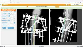 Correcting Leg Deformity Full Surgical Planning Explained with XRays [upl. by Oringa]