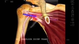 Fallstudie FujiFilm SonoSite Pathologie der Vorderschulter [upl. by Anoel873]