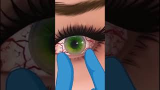 Eyes infection clinging 3D Animation ASMR Video Part2  infected eyes 🤢😷satisfying relaxing [upl. by Rania51]