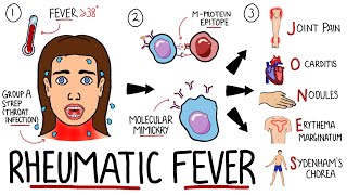 Rheumatic Fever Made Easy Including Jones Criteria and Mnemonic [upl. by Elyrrad354]