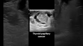 Thyroid Papillary Cancer ultrasound imaging radiology cancer endocrinology cases [upl. by Narhem]