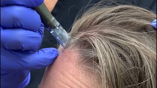 Scalp Microneedling for Hair Loss Treatment microneedlingtherapy hairloss [upl. by Neeka221]