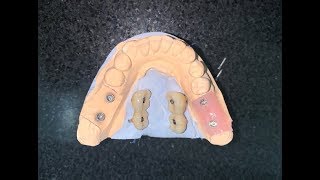 Straumann BLT implants surgery using a vacuum formed modified surgical guide and Variobase abutments [upl. by Analak182]