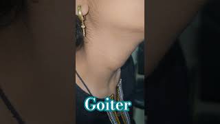 Goiter imwell Doctor Bangalore Medahalli [upl. by Neerual]