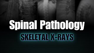 Spinal Pathology Skeletal Xrays [upl. by Ardnekal229]