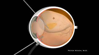 Posterior Vitreous Detachment PVD and Retinal Detachment RD [upl. by Yarazed]