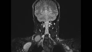 Neurofibromatosis [upl. by Ahsataj585]