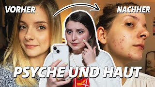 Plötzlich Akne Einfach Pickel oder psychische Belastung acneshaming [upl. by Naima]