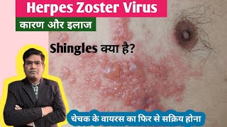 Herpes Zoster Shingles Disease Cause Symptoms and Treatment in Hindi  Varicella Zoster Virus [upl. by Eek]