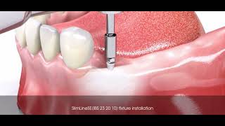 Prothèse amovible CLIPSÉ sur implant bouton pression [upl. by Neih245]