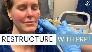 What is a PRP Facelift Are There Any Risks [upl. by Anitsyrk834]