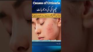 What Causes Urticaria Dr Atif Kazmi Explains Common Triggers [upl. by Philippine253]