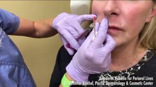 Juvederm Volbella Demo for Perioral Lines around the lips  2068595777 [upl. by Ahsieyk]