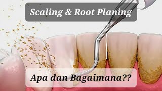 Scaling amp Root Planing  Upaya Mempertahankan Gigi [upl. by Jacquet835]