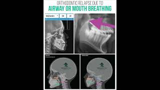 Orthodontic Relapse Due to Airway Issues and Mouth breathing [upl. by Kendell]