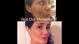 How to Control MELASMA using Derma Roller Micro Needling [upl. by Buzzell]