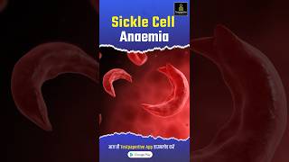 Sickle cell anemia  causes symptoms diagnosis nursing nursingofficer sicklecellanemia [upl. by Amling902]