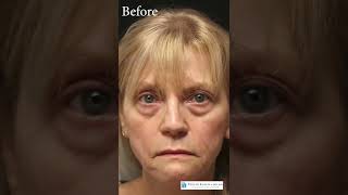 Before and after lower blepharoplasty surgery [upl. by Thgiwd]