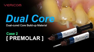 Dual Cured Core Build up Material Premolar 2 [upl. by Marilin]