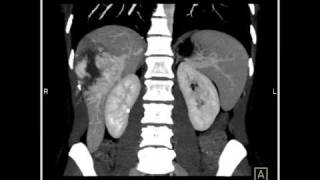 Abdomen Liver Cavernous Hemangioma of the Liver8 of 9 [upl. by Afirahs92]