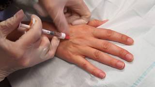 Rejuvenate Medical Spa Skin Boosters of Hand [upl. by Atwater895]