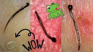 JUICY Hair Follicle Plucks  Satisfying Hair Root Extraction Under Microscope [upl. by Beach]