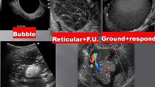 lecture 4 ultrasound of ovary amp adnexa part 1 [upl. by Wexler]