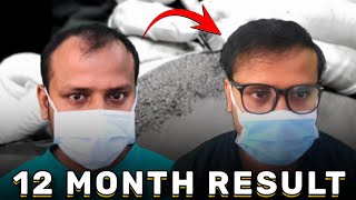 Hair Transplant Result After 1 Year  Dr Jayanta Bain plastic surgeon [upl. by Hatcher]