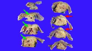 Two causes of obstructive jaundice amp chronic pancreatitis  adenomyoma amp autoimmune pancreatitis [upl. by Ariaes]