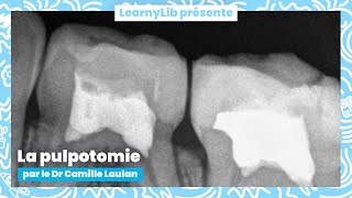 🦷 Pédodontie  les pulpotomies sur dents temporaires avec le Dr Camille LAULAN [upl. by Yekram538]