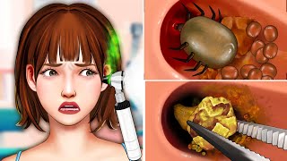 ASMR Ear Cleaning Removing Giant Earwax amp Deep Cleaning Ear  ASMR Ear Treatment [upl. by Rivera642]