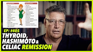 Ep405 THYROID HASHIMOTO AND CELIAC REMISSION [upl. by Toby]