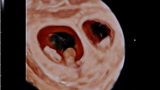 Describe chorionicity and amnionicity [upl. by Zaragoza]