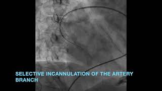 Endovascular embolization of large pulmonary arteriovenous malformations with systemic desaturation [upl. by Kelwunn]