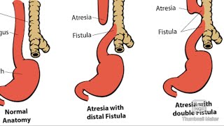 Tracheoesophageal Fistula  TEF and its types [upl. by Nimsaj]