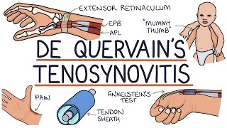 Understanding De Quervain’s Tenosynovitis Mummy Thumb [upl. by Aicile]