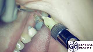 Infiltration anesthesia for extraction 26 tooth and implantation area 2526 [upl. by Llegna]