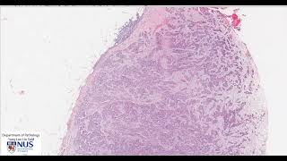 Pleura Mesothelioma epithelioid Microscopy  Talking slide [upl. by Evoy]