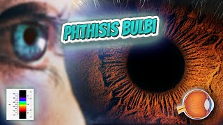 Phthisis bulbi  Your EYEBALLS  EYNTK 👁️👁️💉😳💊🔊💯✅ [upl. by Ettelrac]