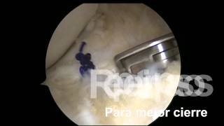 Reparacion menisco lateral cuerno anterior [upl. by Ecirtal]