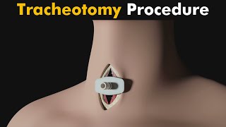 How Tracheotomy is performed  Tracheotomy 3D Animation UrduHindi [upl. by Shult]