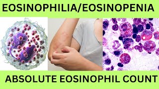 EOSINOPHILIAEOSINOPENIAABSOLUTE EOSINOPHIL COUNTAECHYPEREOSINOPHILIC SYNDROMEEOSINOPHILLEUKEMIA [upl. by Eidnalem]