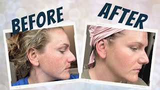 How I Treat My Melasma  ITS WORKING 😱🙌 [upl. by Zadack]