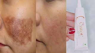 Cysteamine cream reviews for melasma  Cysteo cream how to use  Cysteo cysteamine cream [upl. by Alleinad]