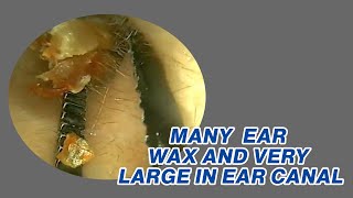 Many Ear Wax And Very Large In Ear II Hard Dry Ear Wax Removal [upl. by Suhcnip]