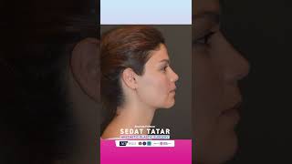 Buccal Fat Removal Double Chin Removal Rhinoplasty Before and After [upl. by Selry]