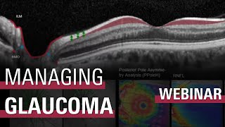 Managing Glaucoma Patients with Confidence [upl. by Tori]